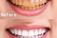 Teeth-Whitening-1