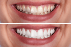 Teeth-Whitening2