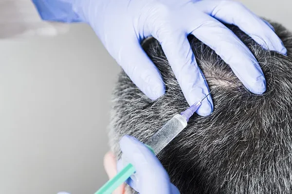 Mesoterapia del Cabello